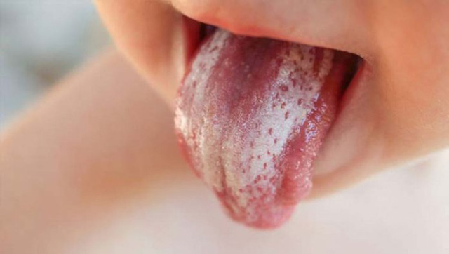 Miconazol là loại thuốc được sử dụng rộng rãi điều trị nhiễm nấm có trong miệng, cổ họng hay ngực