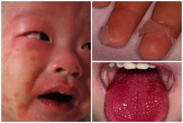 Bệnh Kawasaki chủ yếu xuất hiện ở trẻ em