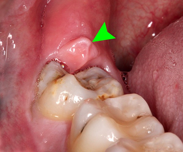 Một số triệu chứng của bệnh khô miệng như có nhiều răng sâu