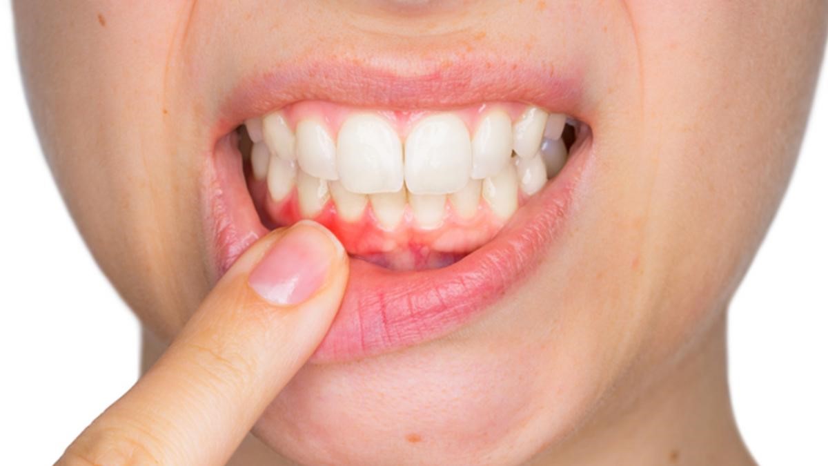 Bệnh khô miệng gây ra các bệnh lý nghiêm trọng như viêm nướu răng