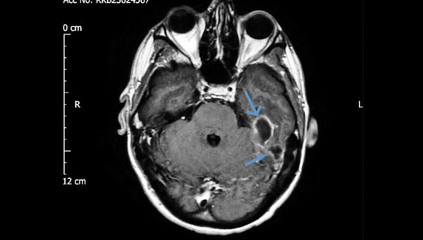 Ảnh chụp CT não bộ của người đàn ông 31 tuổi cho thấy vùng nhiễm trùng