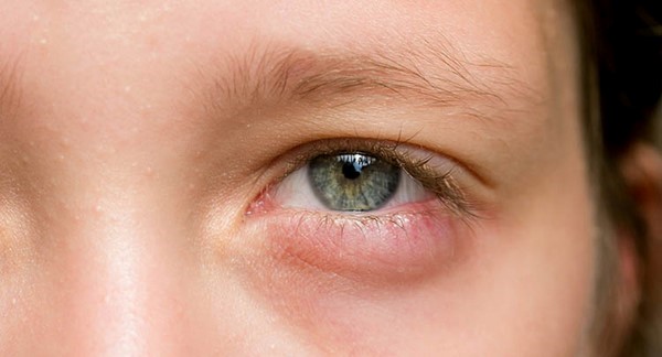 Chấn thương mắt là nguyên nhân thứ 3 gây mù lòa chỉ sau đục thể thủy tinh và glôcôm