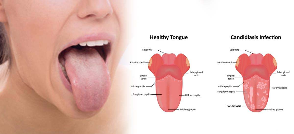 Nấm miệng là một tình trạng mà trong đó các loại nấm Candida albicans tích tụ trên niêm mạc miệng