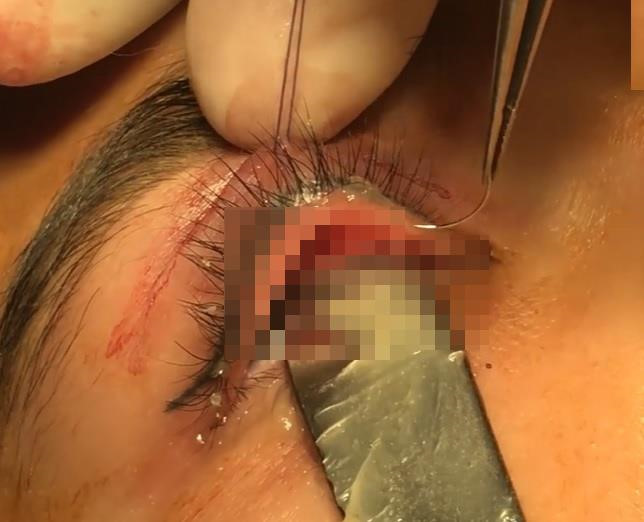 Hình ảnh cây kim gãy trong mí mắt bệnh nhân