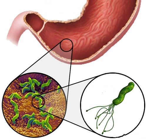 Vi khuẩn H. Pylori là một trong những nguyên nhân gây viêm loét dạ dày