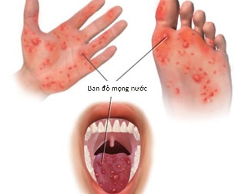 Virus Coxsackievirus gây ra bệnh chân tay miệng