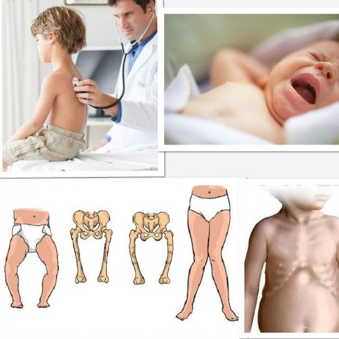 Bệnh còi xương ở trẻ em hiện nay diễn ra rất phổ biến