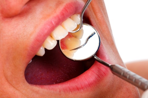 Làm sạch cao răng và mảng bám sẽ giúp chữa khỏi viêm nướu